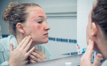 Atopic dermatitis visible symptoms